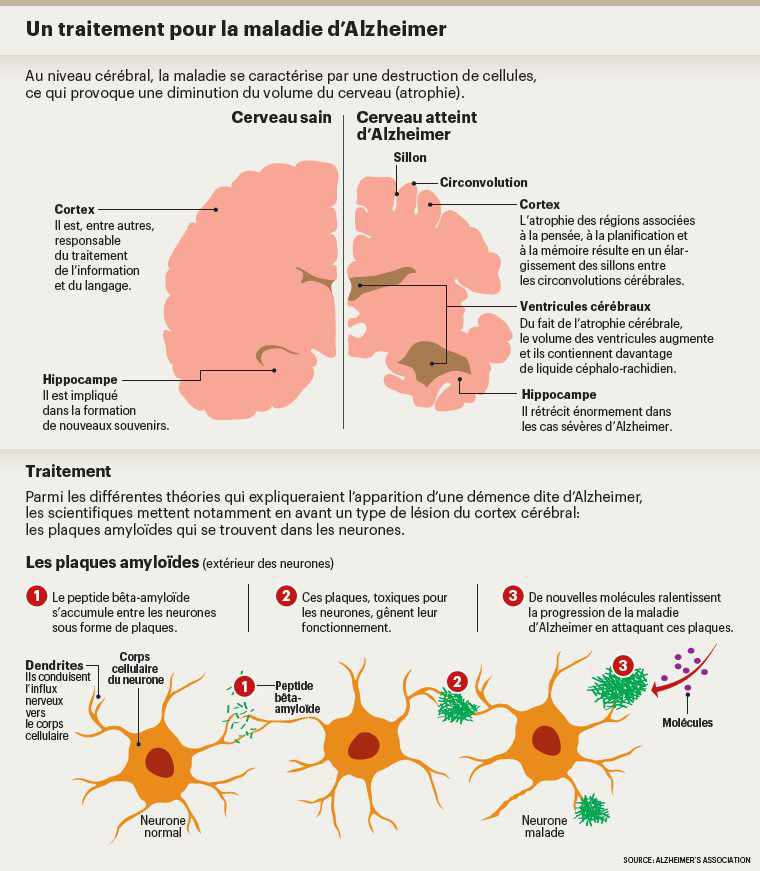 infog médicament alzheimer