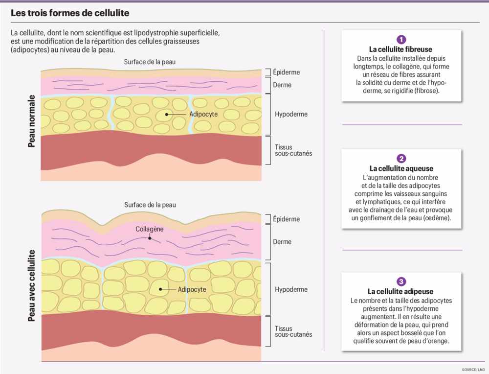 infog_cellulite_meconnue