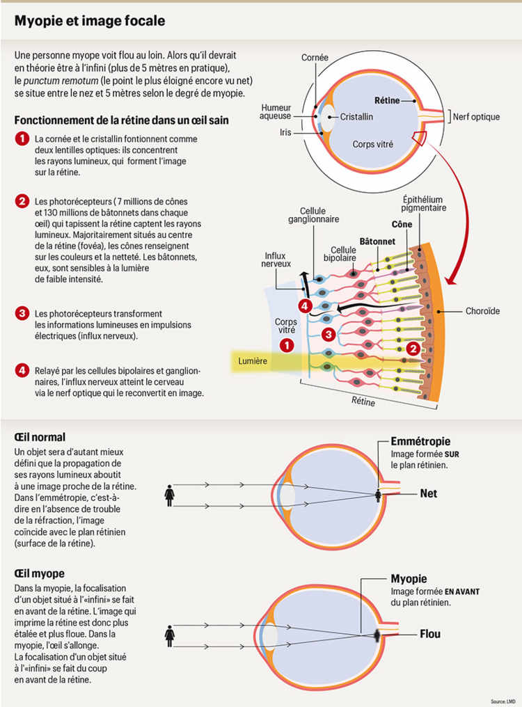 Myopie et image focale