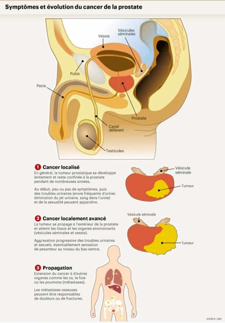 operatie laparoscopica cancer prostata
