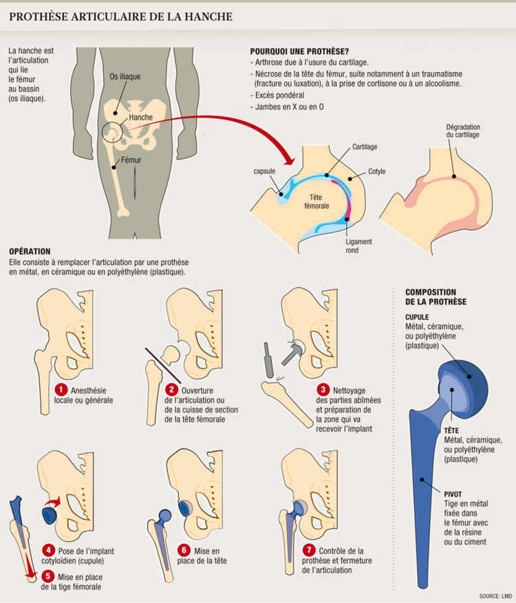 La pose d’une prothèse articulaire est un succès à 95%