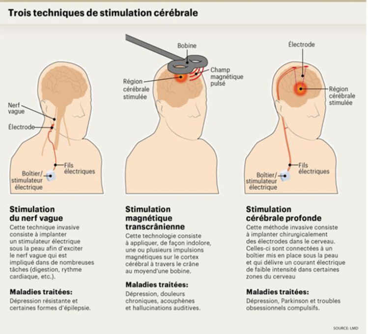 Trois techniques de stimulation cérébrale
