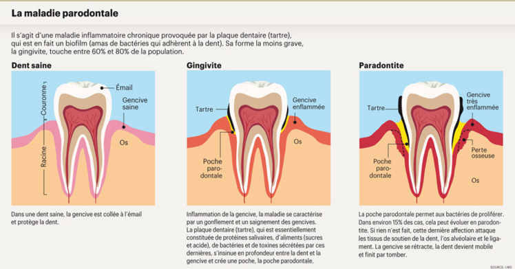 La maladie parodontale