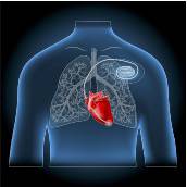 36.9_implant_cardiaque_rend_fou_36.9