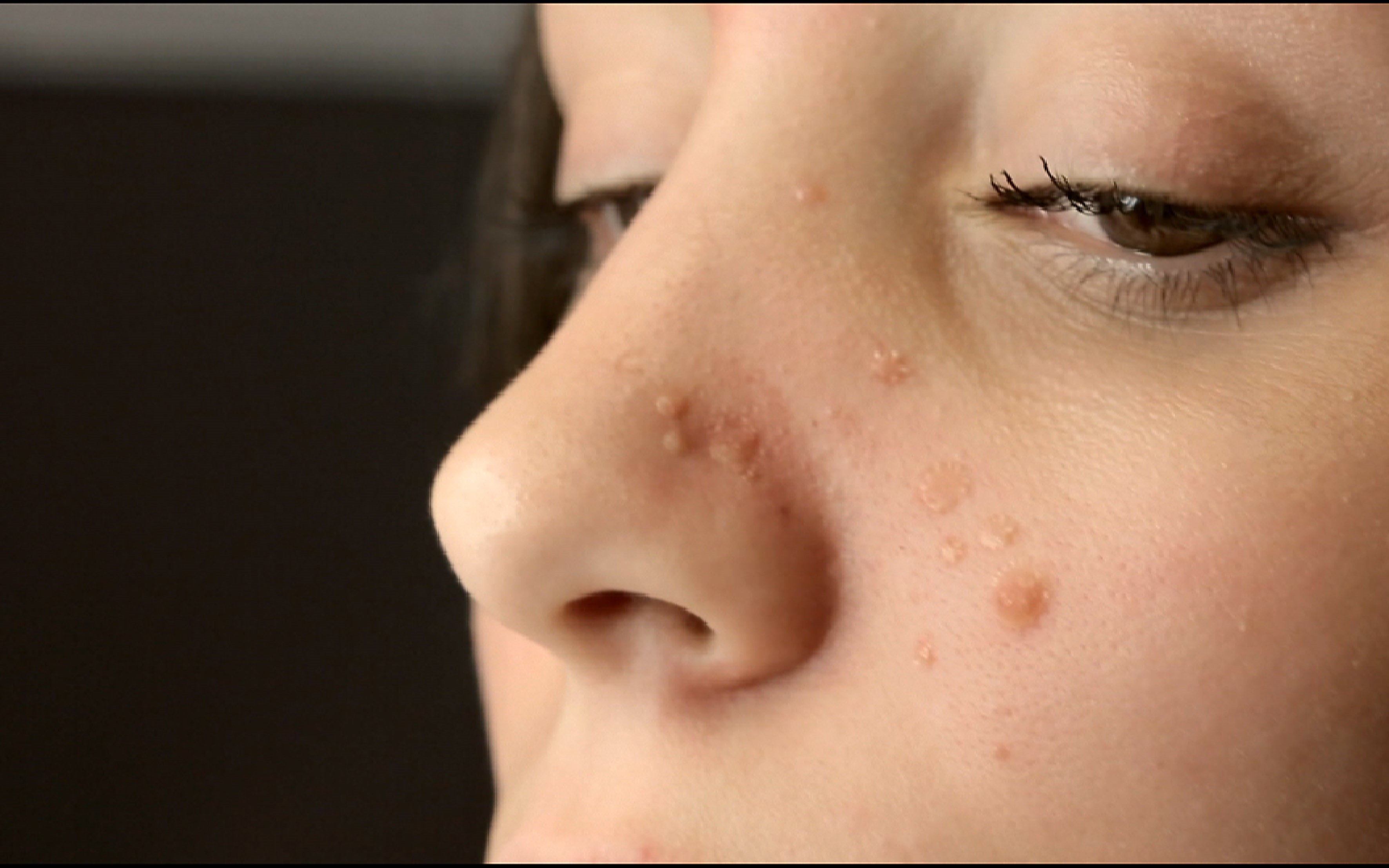 Prescriptions contre l'acné: le scandale continue! - Planete sante