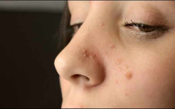 36.9_acne_scandale
