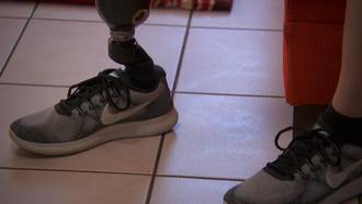 36.9_chronique_amputation