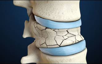 36.9_osteoporose_remede