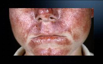 36.9_Protoporphyrie_erythropoietique