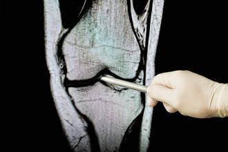 osteoporose_os_fragilisent