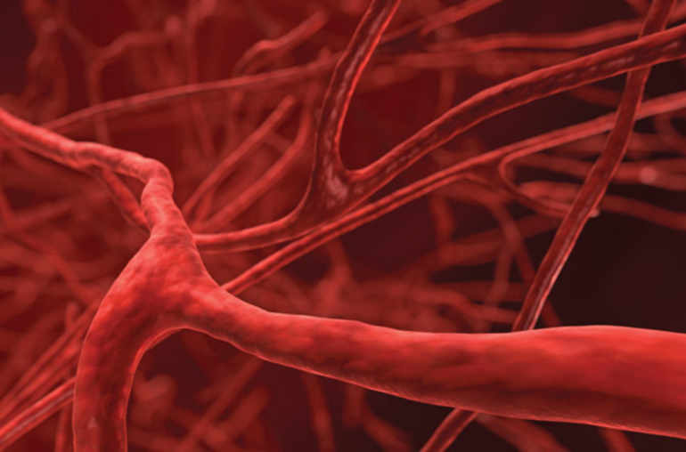 Quoi de neuf dans le traitement de la thrombose veineuse profonde?