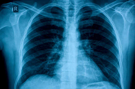 une radiographie des poumons
