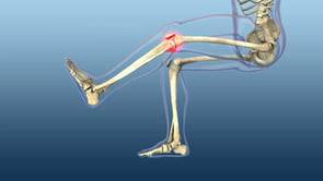 Arthrose: comme un clou dans le genou