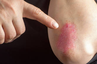 Les malades du psoriasis sont encore trop souvent ostracisés